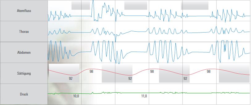 Klinischer Algorithmus zum Einsatz der ASV-Therapie